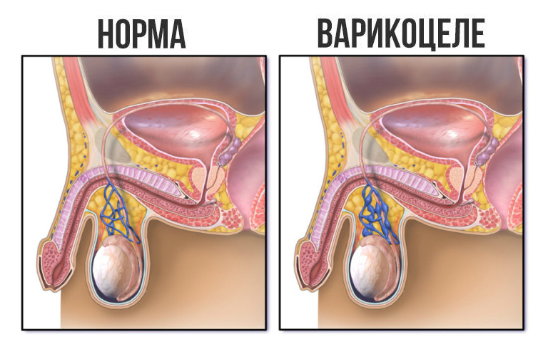 Қалыпты және варикоцеле бейнесі