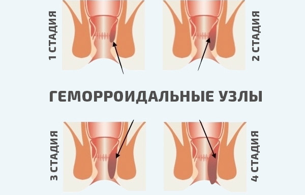 Геморройдың пролапсының кезеңдері