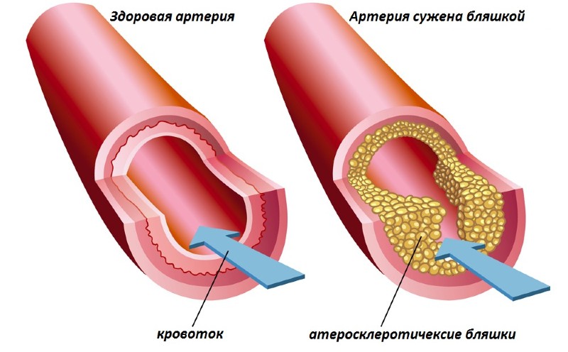 Облитерирующий атеросклероз вен